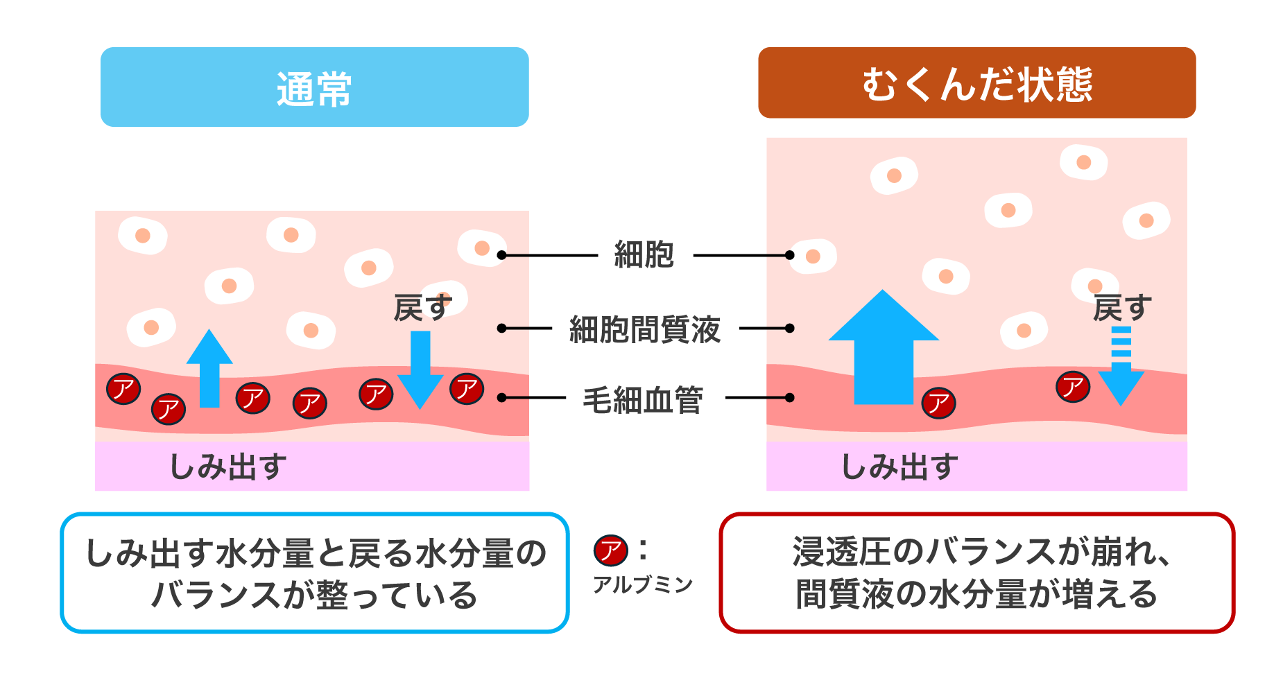 むくみの原因は血液中のアルブミン不足?毛細血管の水分量を保つタンパク質のメカニズム | 分子栄養学タイムズ